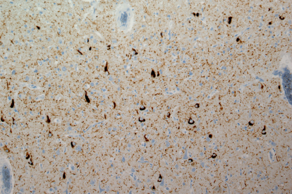Tau protein buildups (shown in brown) in the brain of a person who died of nodding syndrome