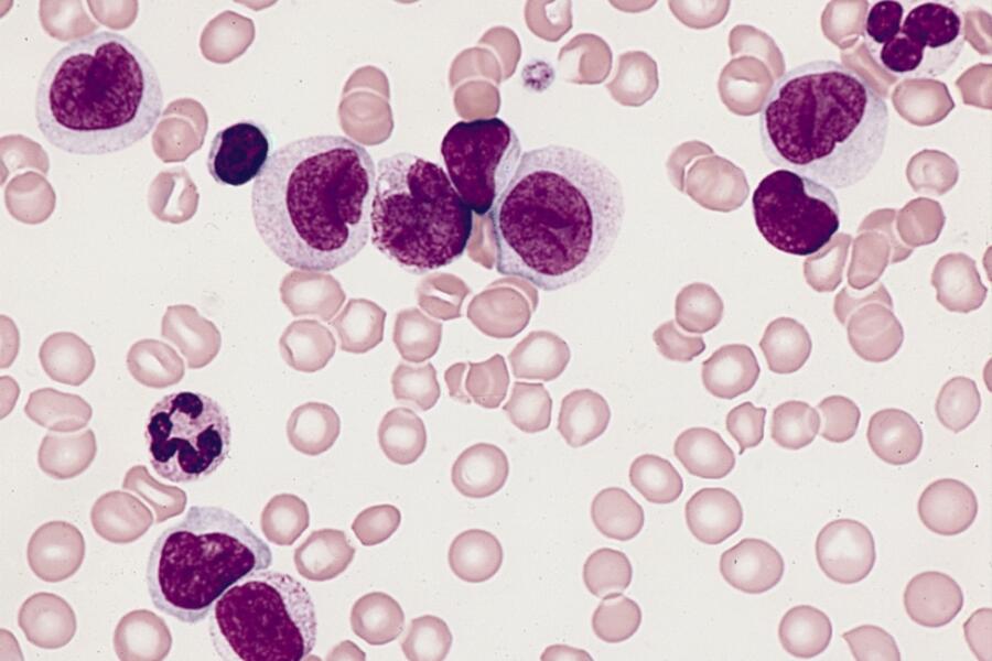Leukemia Cells