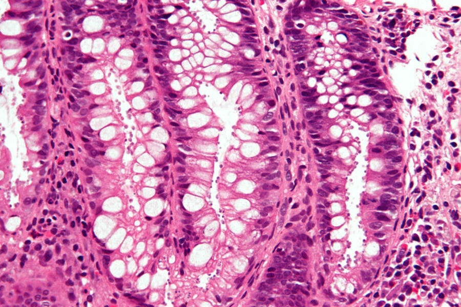 Cryptosporidiosis