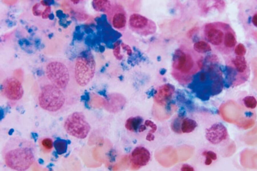 Photo: photomicrograph of bone marrow tissues showing a normal amount of iron stores using Prussian blue stain.