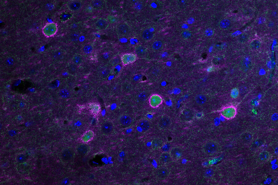 Chemogenetics rescues the health of perineuronal nets (pink) that surrounds neurons (green) in the ALS mouse brain.