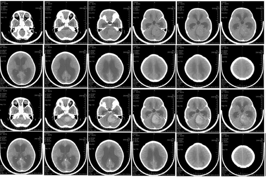 A brain scan of child with medulloblastoma