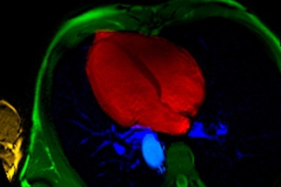 MRI heart image