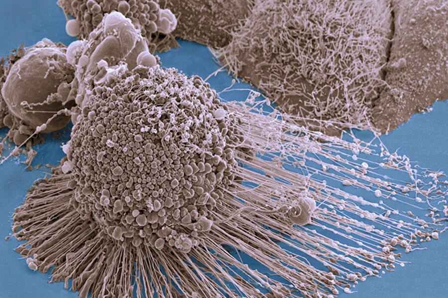 cancer cells dividing in a laboratory dish