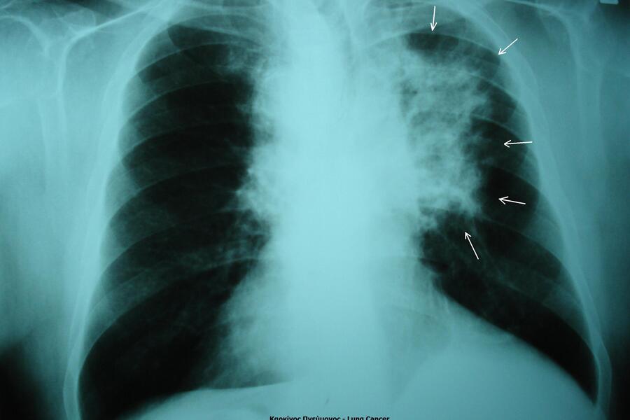 Lung cancer in xray