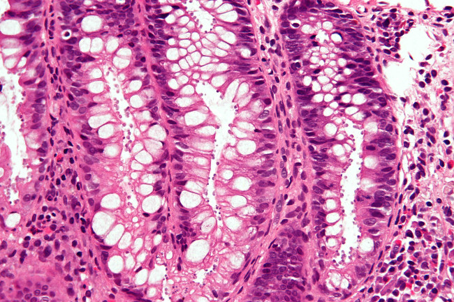 Cryptosporidiosis