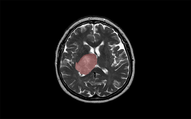 Glioblastoma