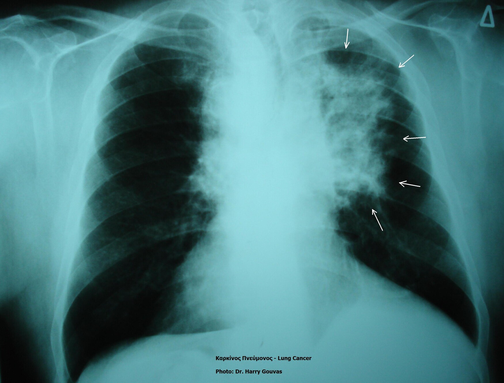 Lung cancer in xray